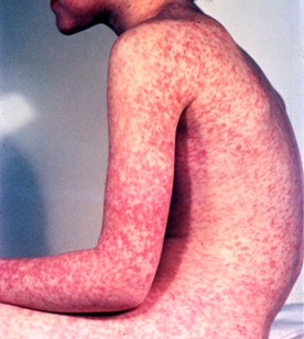 measles-boy-sideview